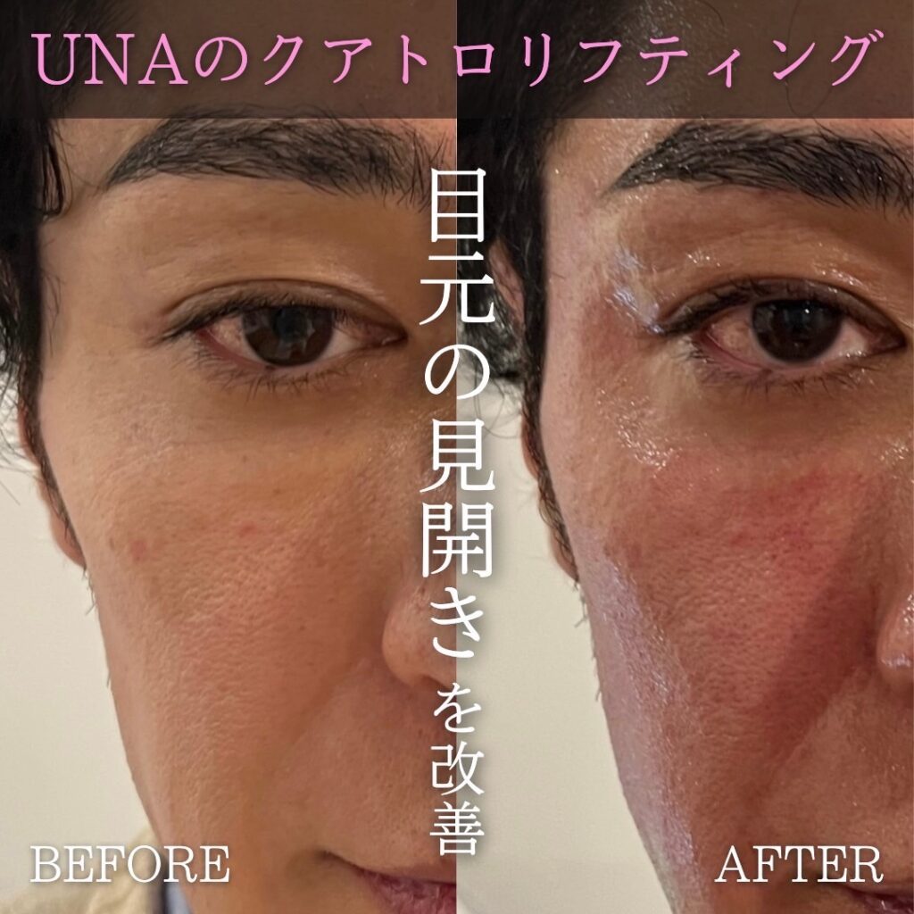 UNAのクアトロリフティングビフォーアフター