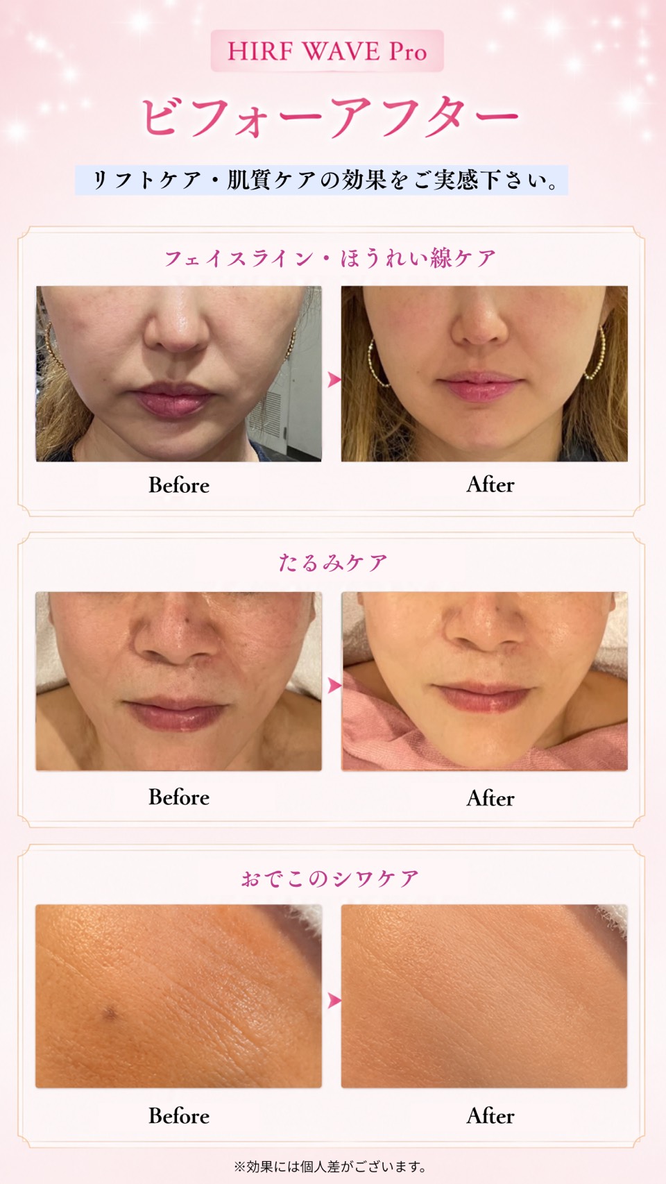 HIRF WAVE Proのビフォーアフター症例写真：フェイスライン・ほうれい線ケア、たるみケア、おでこのシワケアの比較